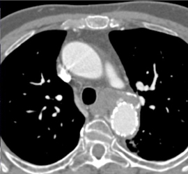 Stent for Repair of Thoracic Aneurysm - CTisus CT Scan