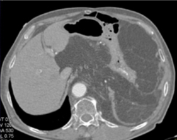 Liposarcoma - CTisus CT Scan