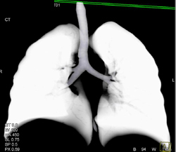 Normal Airway With Tracheal Bronchus - CTisus CT Scan