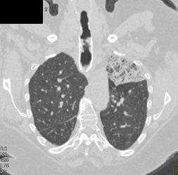 Left Upper Lobe Infiltrate - CTisus CT Scan