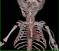 CTA in Child Using Various Rendering Techniques - CTisus CT Scan