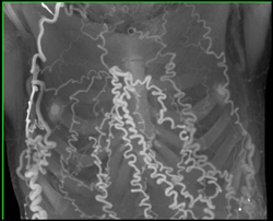 SVC Occlusion With Collaterals - CTisus CT Scan