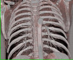 SVC Occlusion With Collaterals - CTisus CT Scan