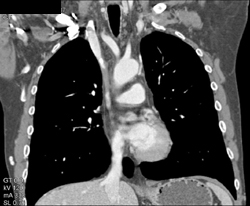 SVC Occlusion With Collaterals - CTisus CT Scan