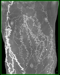 SVC Occlusion With Collaterals - CTisus CT Scan