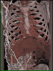 SVC Occlusion With Collaterals - CTisus CT Scan