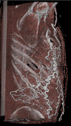 SVC Occlusion With Collaterals - CTisus CT Scan