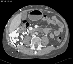 Collaterals Drain Into Renal Vein and IVC - CTisus CT Scan