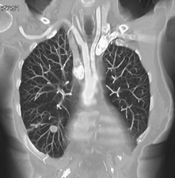 Hamartoma Right Lower Lobe - CTisus CT Scan