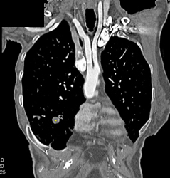 Hamartoma Rl - CTisus CT Scan