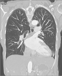 Pulmonary Vasculature With VRT and MIP - CTisus CT Scan