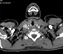 Dissection Extends Into Subclavian Artery - CTisus CT Scan