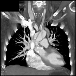 Dissection Extends Into Left Carotid Artery - CTisus CT Scan