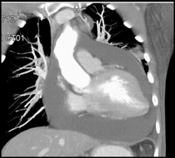 Huge Pericardial Effusion - CTisus CT Scan