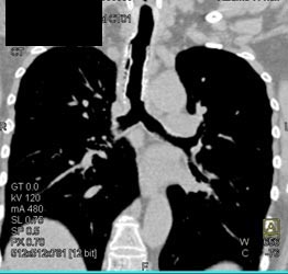 Stent in Trachea in Patient With Primary Tracheal Carcinoma - CTisus CT Scan