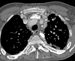 SVC Occlusion With Mediastinal Collaterals - CTisus CT Scan