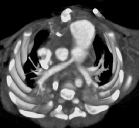 Transposition of the Great Vessels S/P Repair - CTisus CT Scan