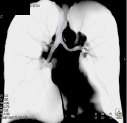 Left Lower Lobe Collapse Due to Central Obstruction By Carcinoma - CTisus CT Scan