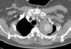 Endovascular Stent With Endoleak - CTisus CT Scan