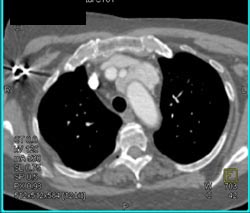 Thymoma - CTisus CT Scan