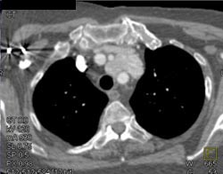 Thymoma - CTisus CT Scan