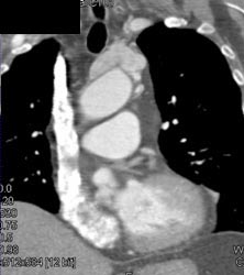 Thymoma - CTisus CT Scan