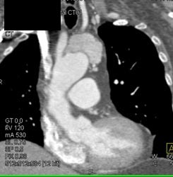 Thymoma - CTisus CT Scan