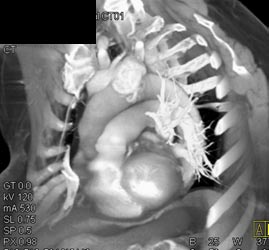 Thymoma - CTisus CT Scan