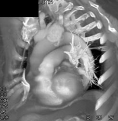 Thymoma - CTisus CT Scan