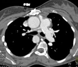 Stenosis of Right Pulmonary Artery - CTisus CT Scan