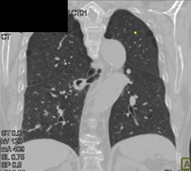 Central Lung Cancer-carcinoid Variety - CTisus CT Scan