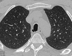 Tracheal Diverticulum - CTisus CT Scan