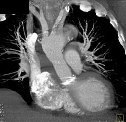 Normal Aortic Valve Replacement - CTisus CT Scan