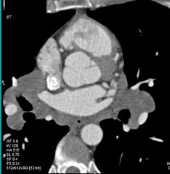 Incidental Sarcoidosis on Cardiac Ct - CTisus CT Scan