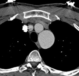 Pseudocoarctation of the Aorta - CTisus CT Scan