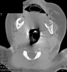 Tracheal Stenosis - CTisus CT Scan