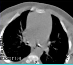 Tracheal Stenosis - CTisus CT Scan