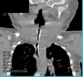 Tracheal Stenosis - CTisus CT Scan