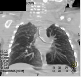 Tracheal Stenosis - CTisus CT Scan