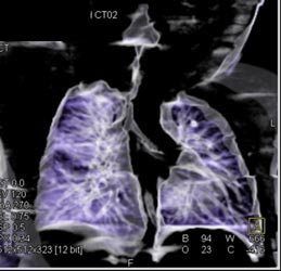 Tracheal Stenosis - CTisus CT Scan