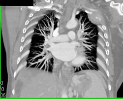 Metastatic Hepatoma - CTisus CT Scan