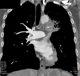 Tumor Encases the Pulmonary Artery - CTisus CT Scan