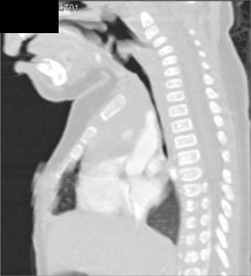 Subglutic Stenosis - CTisus CT Scan