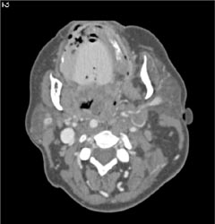 Neck Mass With Jugular Vein Thrombosis - CTisus CT Scan