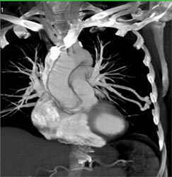 Pulmonary Arterial Venous Malformation - CTisus CT Scan