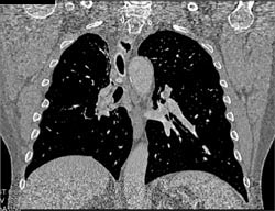 Carcinoid Right Mainstem Bronchus - CTisus CT Scan