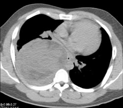 Neurogenic Sarcoma - CTisus CT Scan