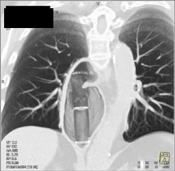 Slipped Stent - CTisus CT Scan