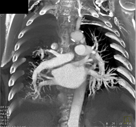 Increased Pulmonary Blood Flow to Lower Lung Fields - CTisus CT Scan