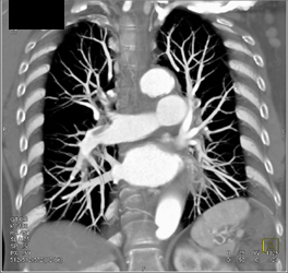 Pulmonary Embolism - CTisus CT Scan